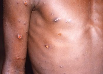 मङ्कीपक्सको डाबर कसरी छुट्टाउने, कतिबेला जाँच गर्ने ?