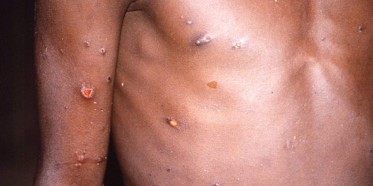 मङ्कीपक्सको डाबर कसरी छुट्टाउने, कतिबेला जाँच गर्ने ?