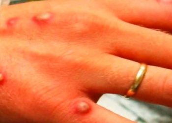 यूरोपमा फैलिरहेको ‘मन्की पोक्स’ कस्तो रोग ?