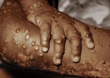 ‘मङ्कीपक्सका कारण विश्वलाई गम्भीर चुनौती’ : डब्ल्यूएचओ